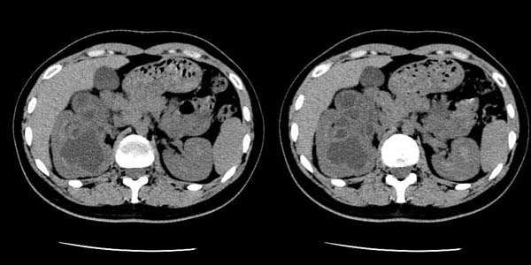 系统 69 查看内容  女,22y,腰痛2月余,外院ct疑右肾上腺嗜铬细胞瘤