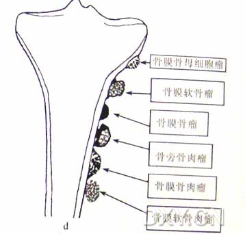 zt0090:骨肿瘤诊断分析要点