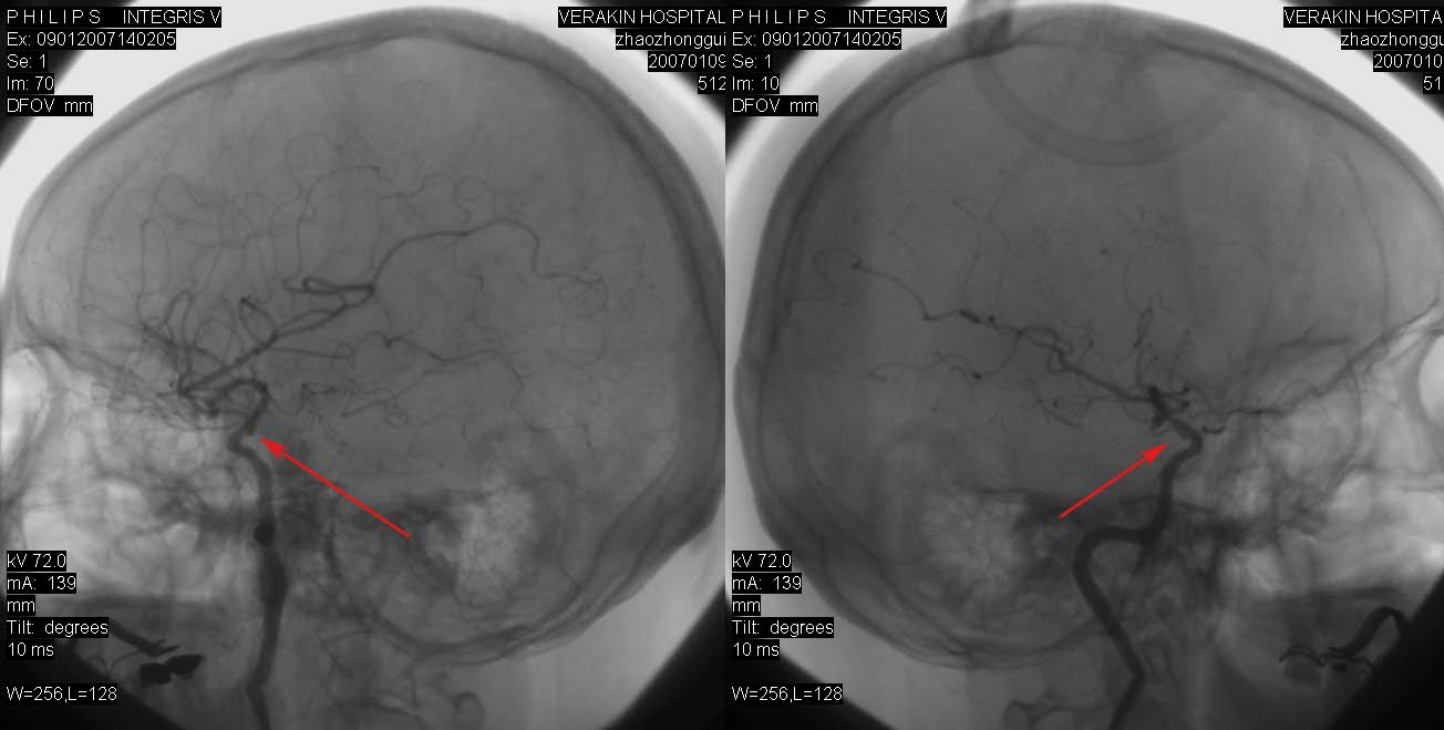 dsa0072:右颈内动脉c6段动脉瘤欣赏!---资料jiajie提供