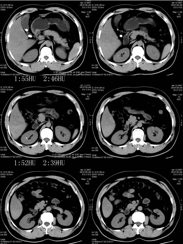 bg0025:ct平扫-脂肪肝,胆囊结石,肾结石