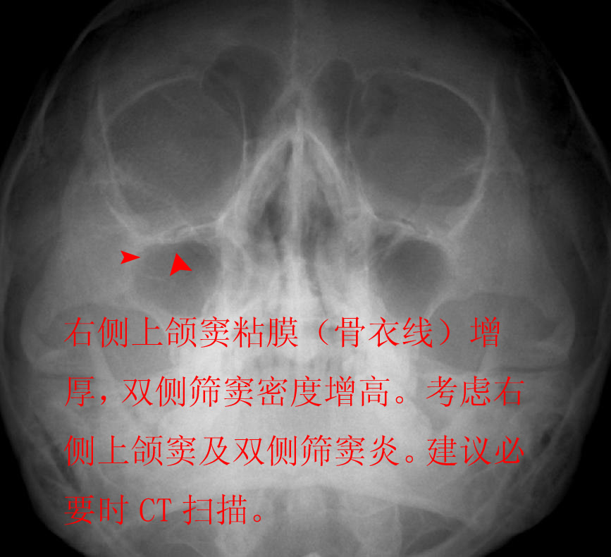 双侧上颌窦及筛窦炎