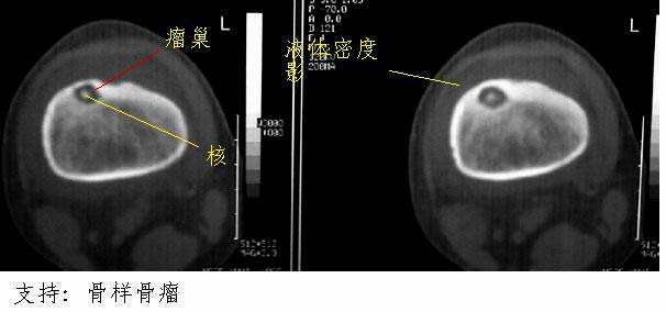 zt0143e:骨肿瘤-骨样骨瘤