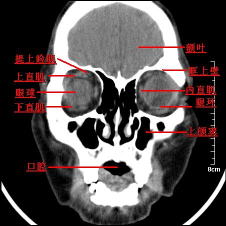 颌面部冠状断层ct解剖(请指教不足)