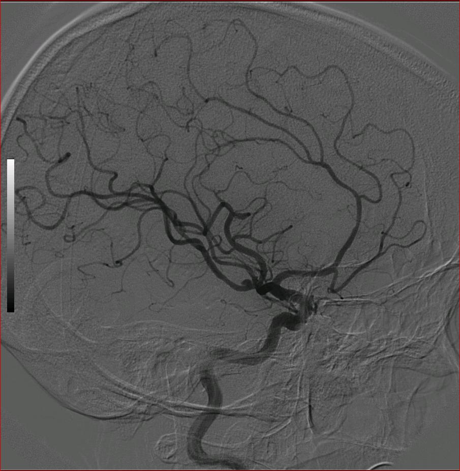 dsa0130:m66y,脑血管造影