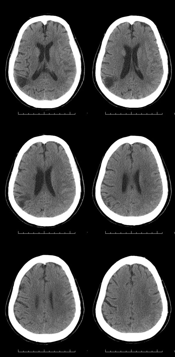 3,双侧基底节区,右侧放射冠区多发性腔隙性脑梗塞同前片.