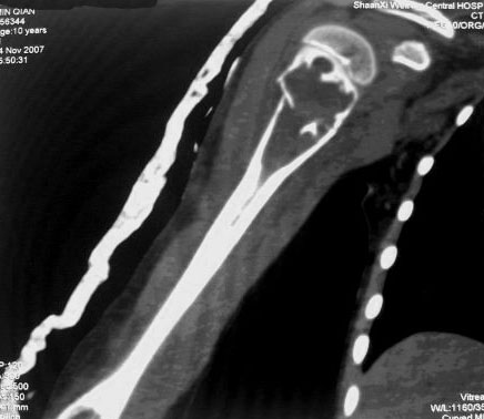 new0332:肱骨上段骨囊肿并病理性骨折