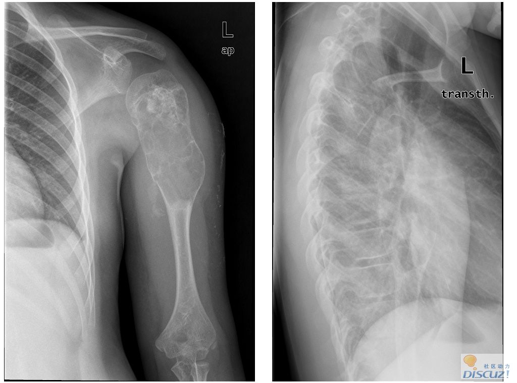 ped0489:转载,女性 11岁,两年前左侧肱骨上段骨囊肿手术,并