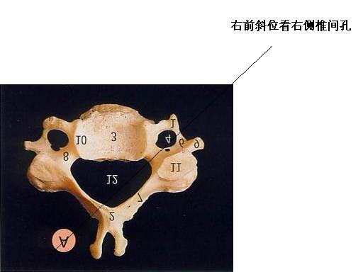 dy1032请教颈椎斜位的投照问题