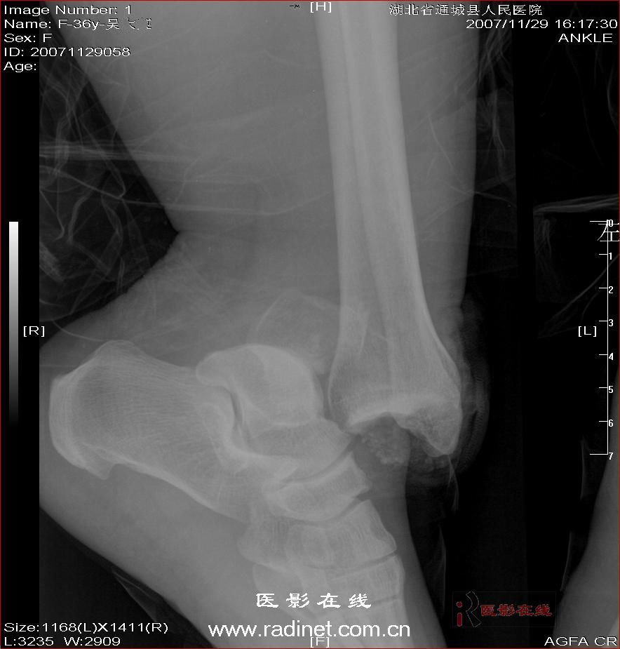 cl0637:踝关节脱位