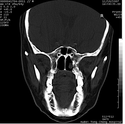 zhengfaming 发言:考虑囊肿 qiuleiyu 发言:下颌骨颏部囊性膨胀性骨质