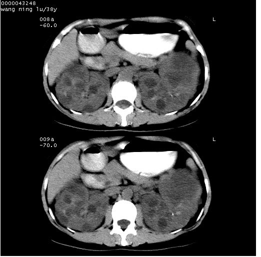 ct0677:多囊肾
