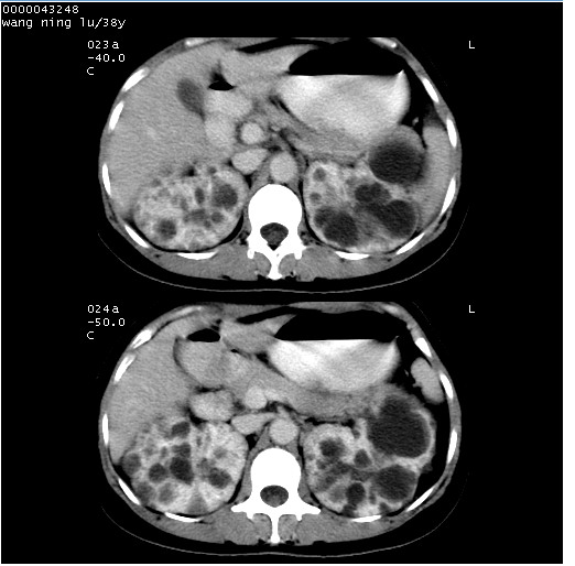 ct0677:多囊肾