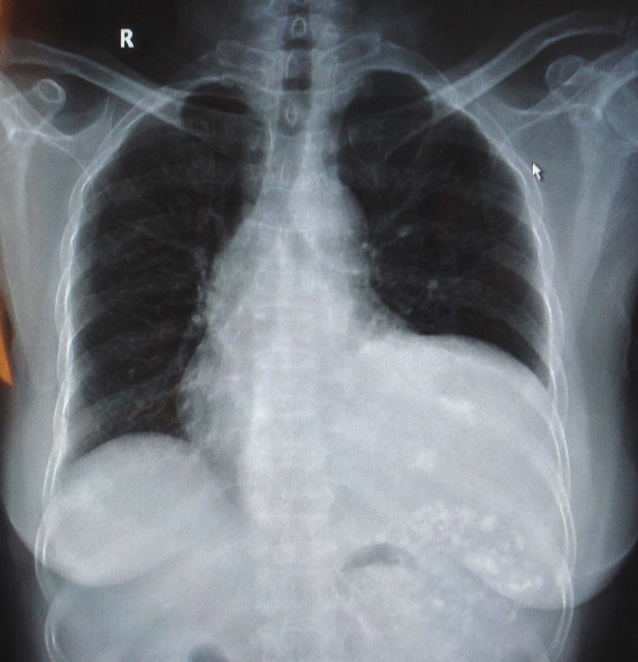 ct11996f75y腹腔异常占位请专家会诊