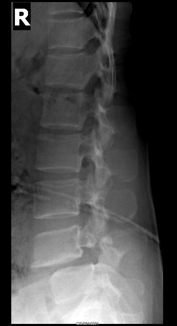 cl0720:腰4椎弓断裂,腰4滑脱(2度)一例!