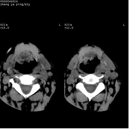 但临床有结核病史,病灶境界不清,上下范围过大,内部密度不均,喉结核不