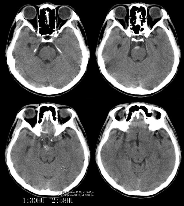 ct12721:蛛网膜下腔出血还是脑干出血?