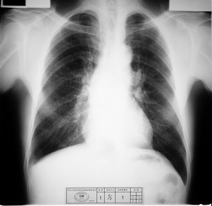 本人上传一部分诊断为尘肺的胸片,供大家学习一下.