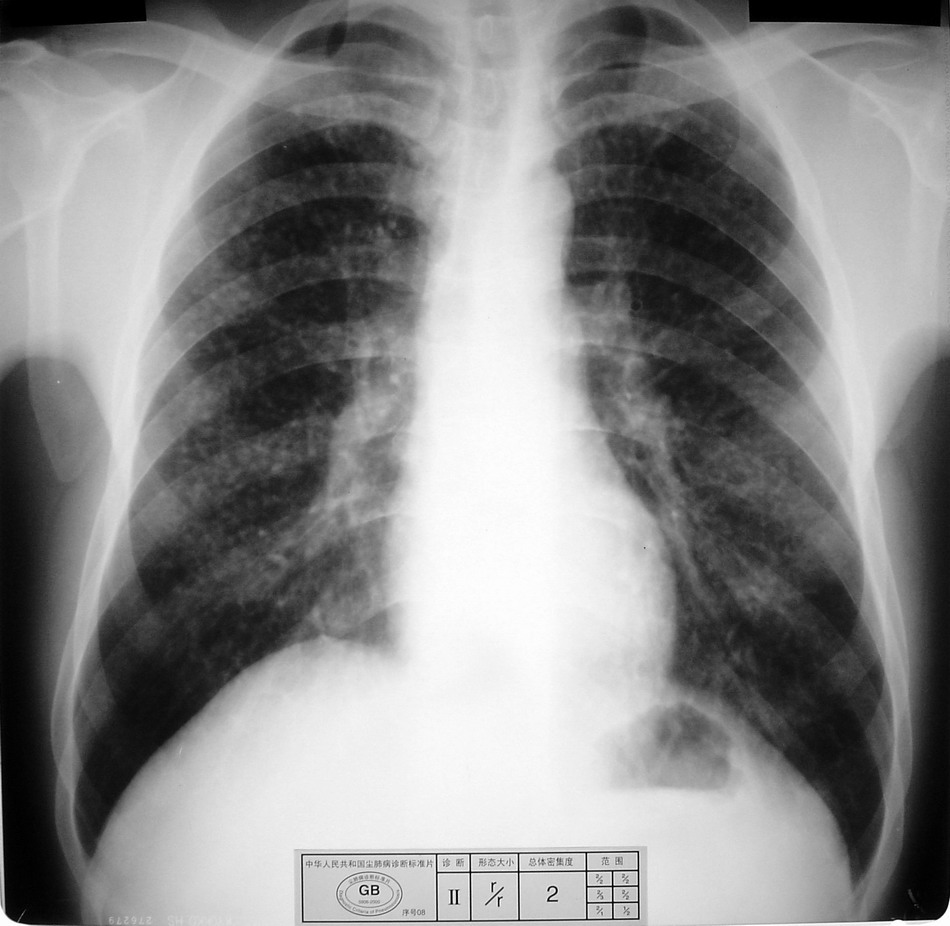 cl0751标准尘肺片
