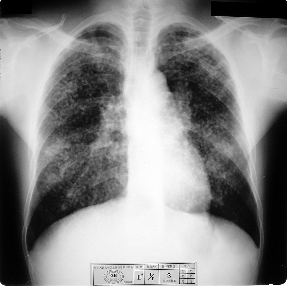 cl0751:标准尘肺片