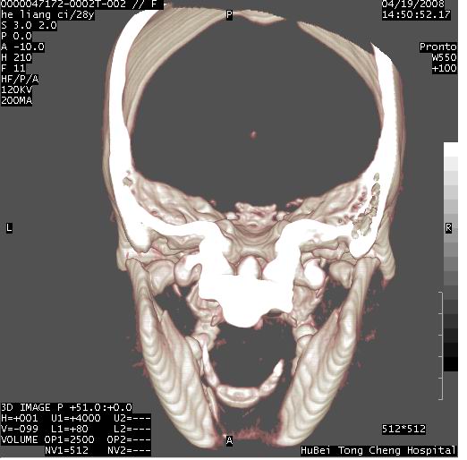 cl0758:双侧髁状突骨折并双侧颞颌关节(tmj)脱位.