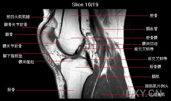 膝关节矢状位mri解剖图谱