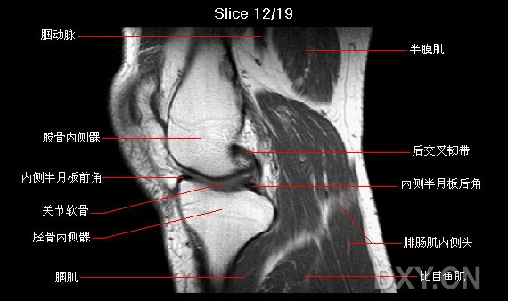 膝关节矢状位mri解剖图谱 - 影像解剖 医影在线