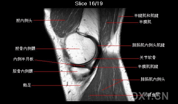 膝关节矢状位mri解剖图谱