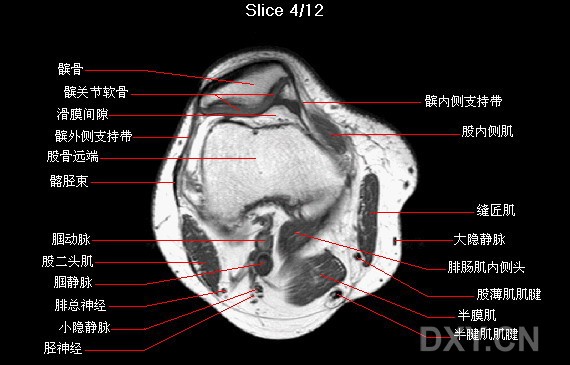 膝关节横轴位mri解剖图谱