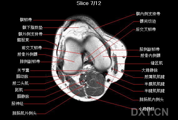 膝关节横轴位mri解剖图谱