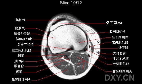 膝关节横轴位mri解剖图谱