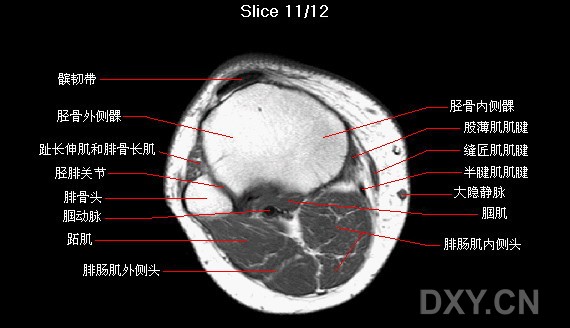 膝关节横轴位mri解剖图谱