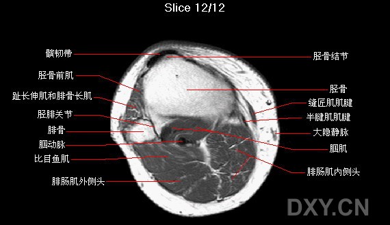 膝关节横轴位mri解剖图谱
