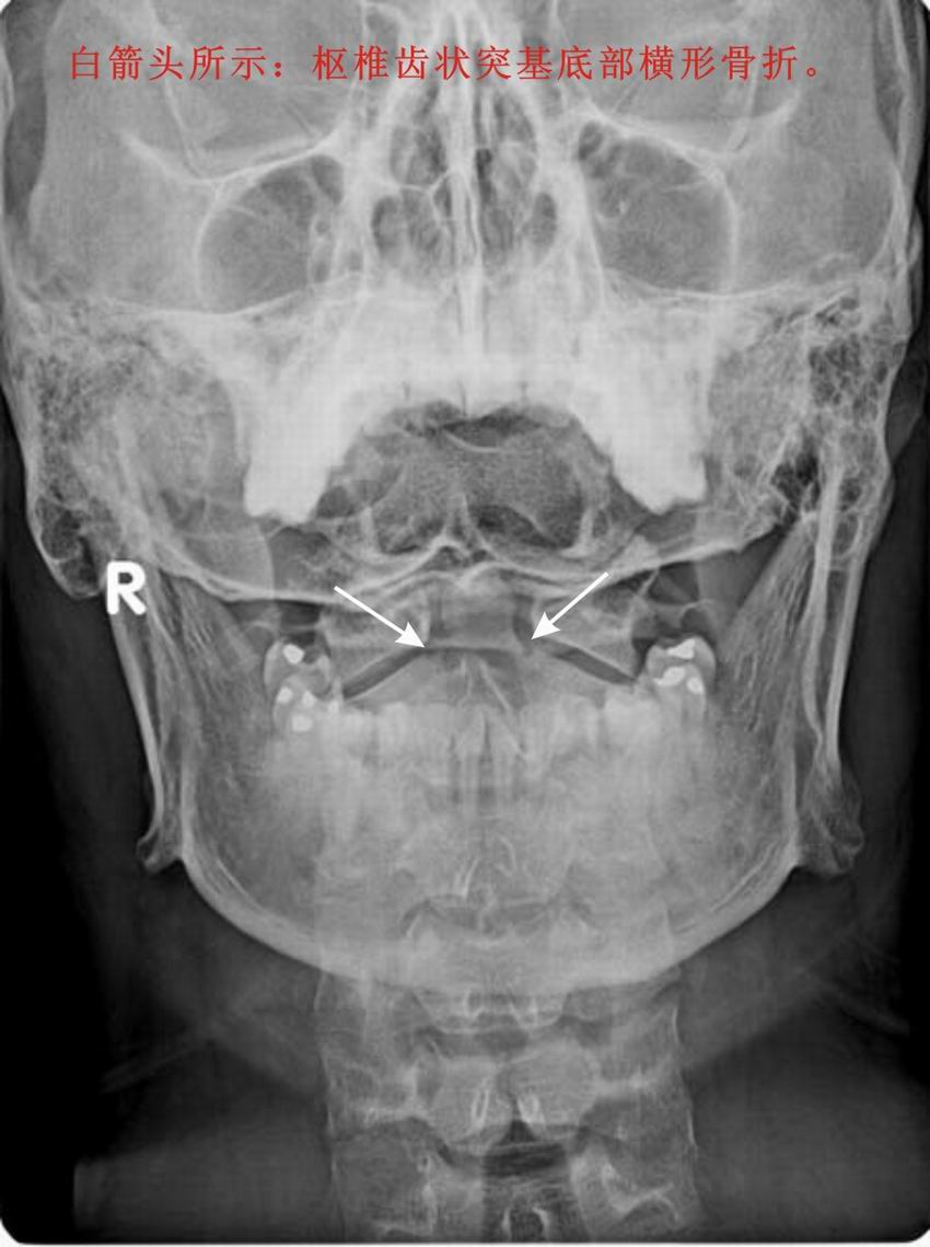 该患者是否有外伤史,如有外伤史,可以肯定颈椎枢椎齿状突基底部骨折