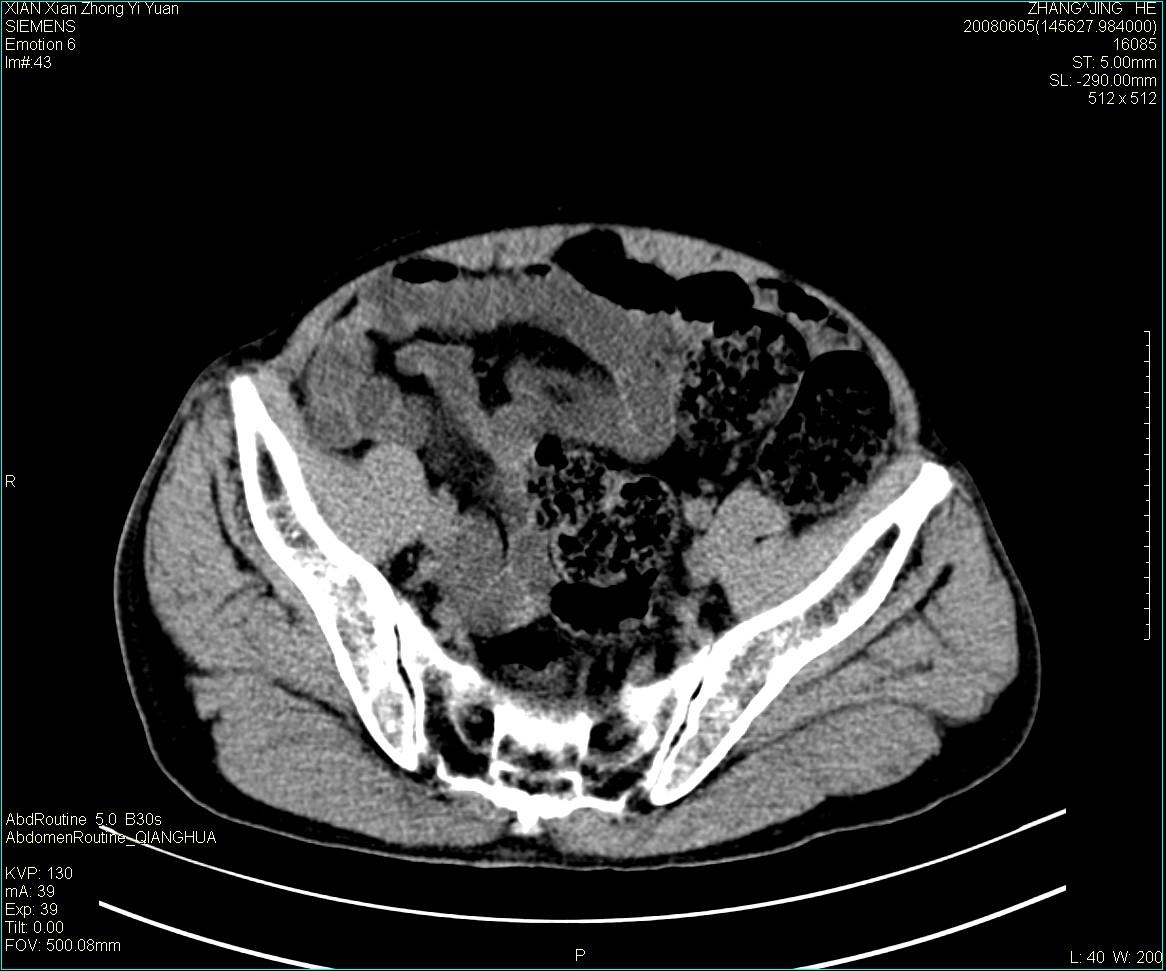 ct13895:m79,典型膀胱癌一例