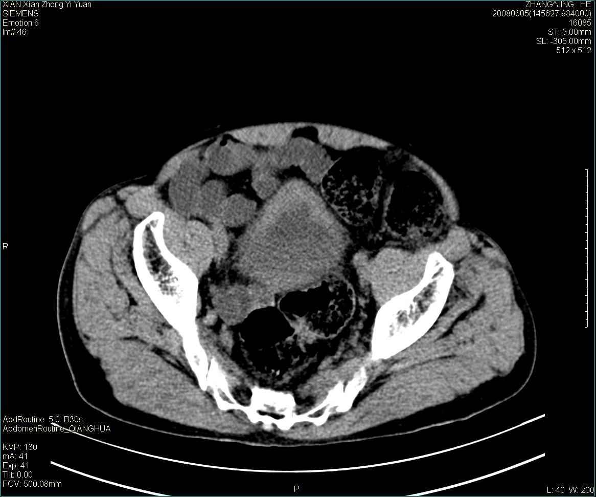 ct13895:m79,典型膀胱癌一例