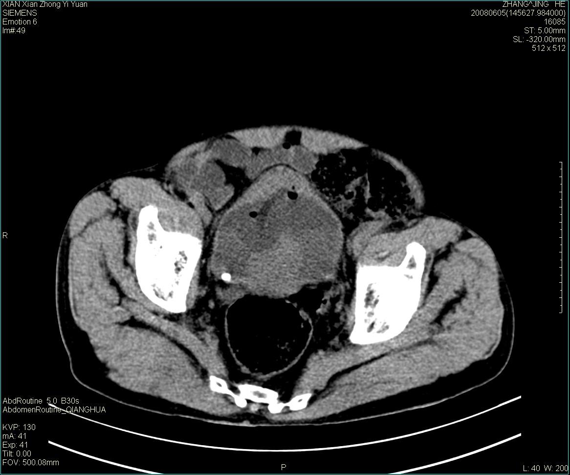 ct13895m79典型膀胱癌一例