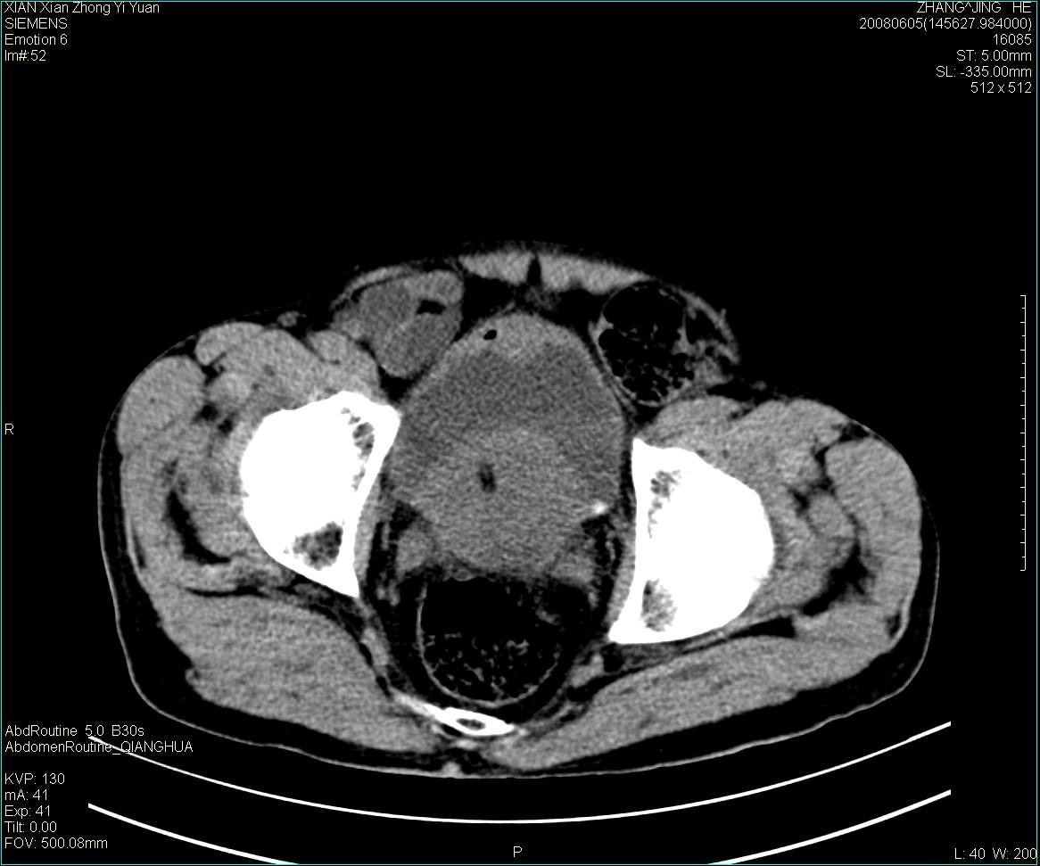 ct13895:m79,典型膀胱癌一例