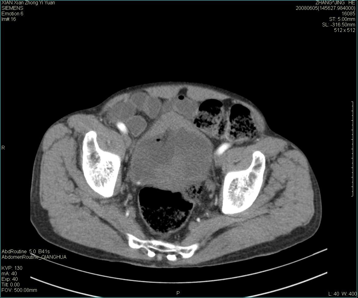 ct13895m79典型膀胱癌一例