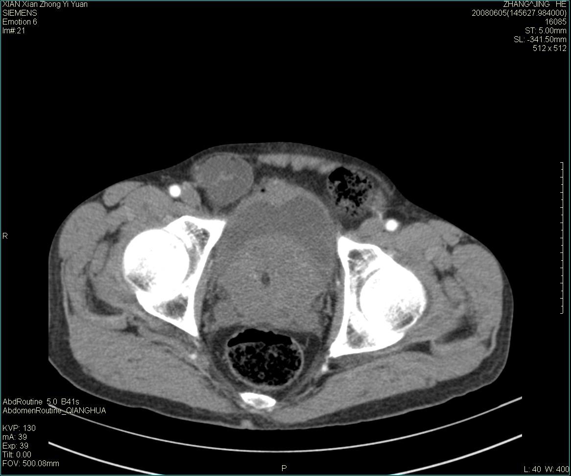 ct13895:m79,典型膀胱癌一例