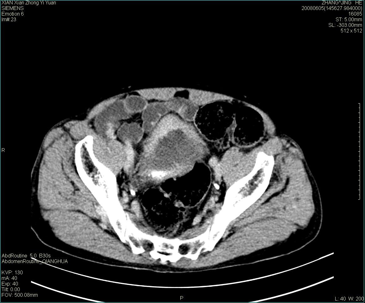 ct13895:m79,典型膀胱癌一例