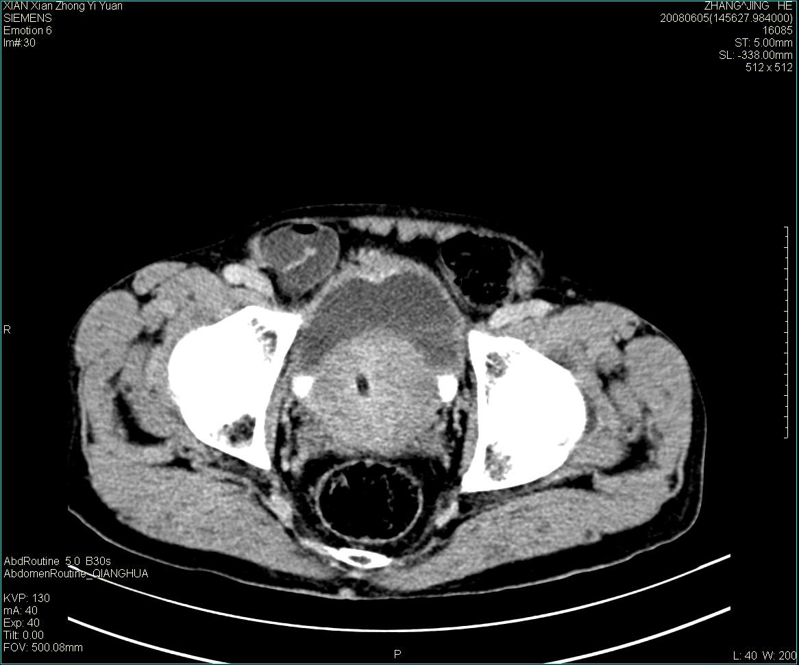 ct13895m79典型膀胱癌一例