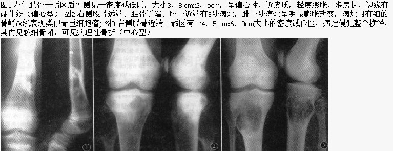 zt0227:纤维骨皮质缺损及非骨化性纤维瘤的影像诊断