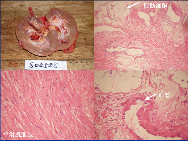 肾脏血管平滑肌脂肪瘤