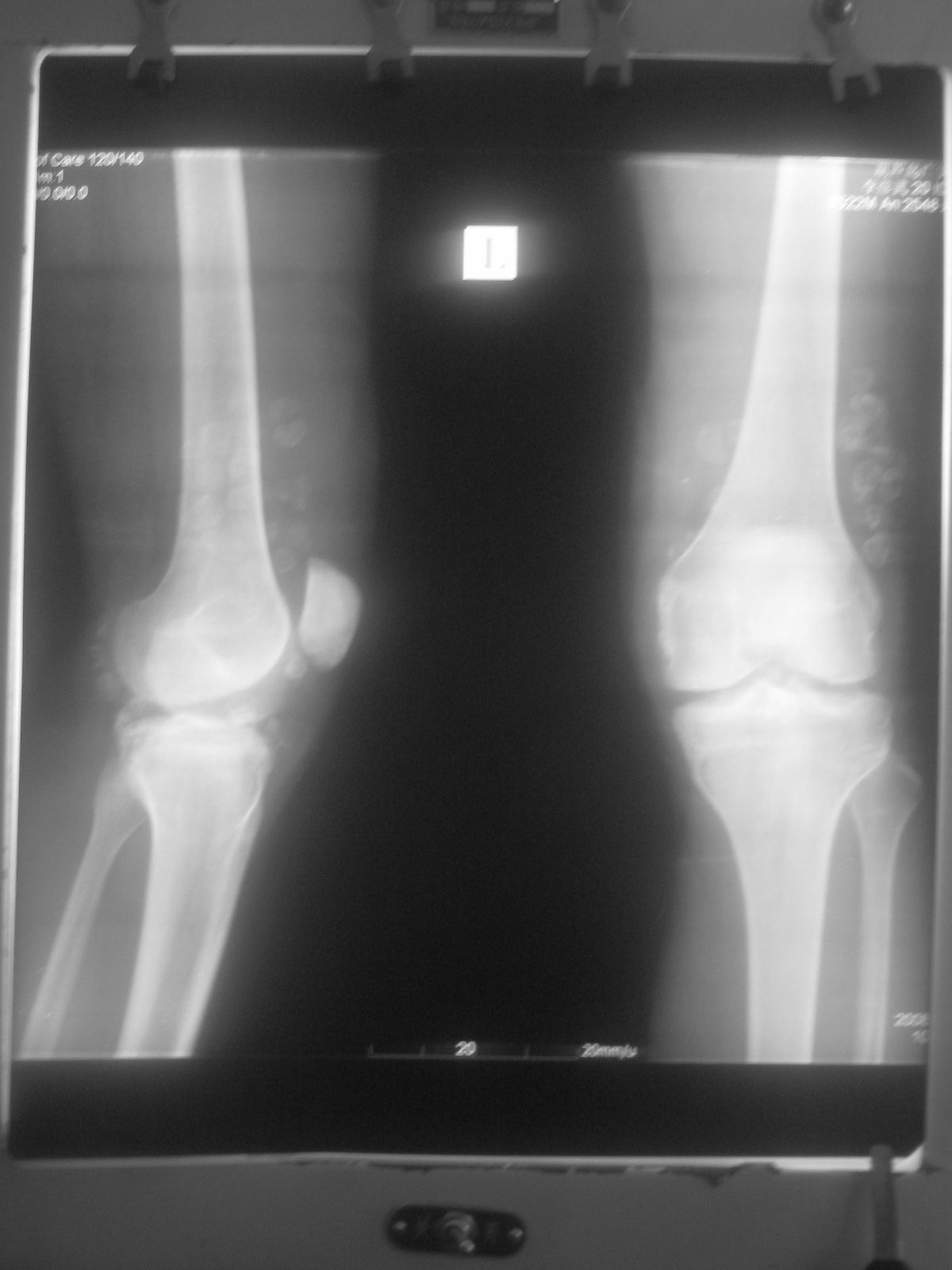 cl0859:左膝关节多发性滑膜软骨瘤