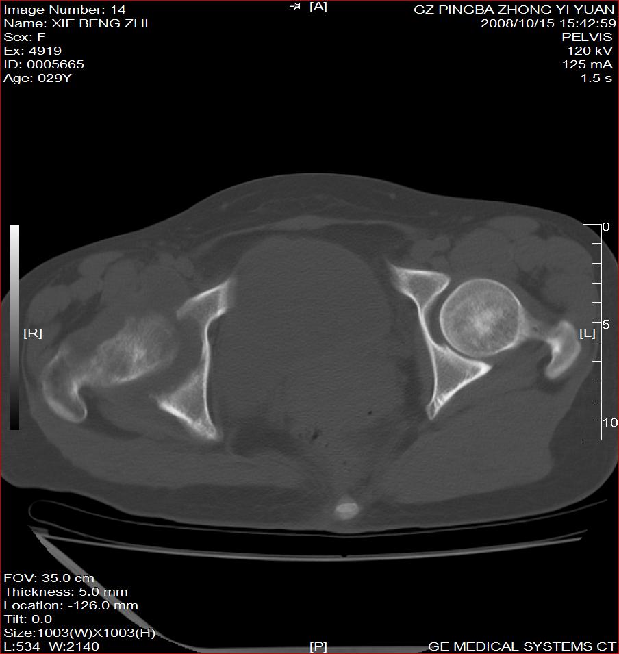 ct16300:髋关节结核?化脓性关节炎?