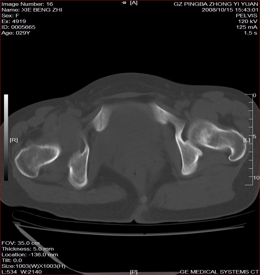 ct16300:髋关节结核?化脓性关节炎?
