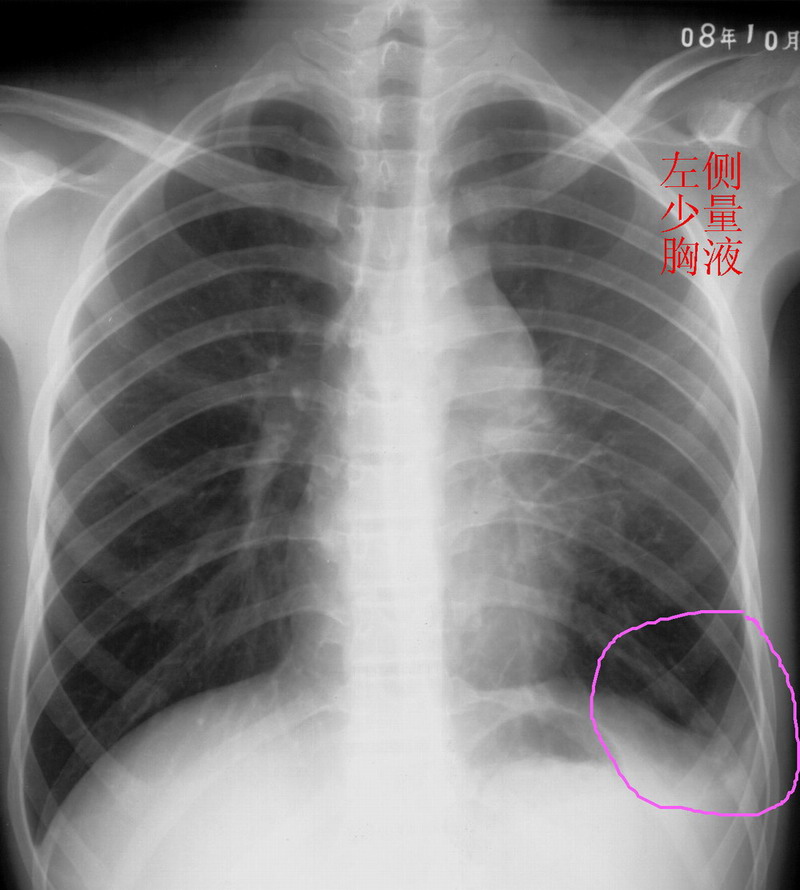 左上纵隔肿块 左侧肺气肿 左侧少量胸液 年青男性=结核?\肿瘤?