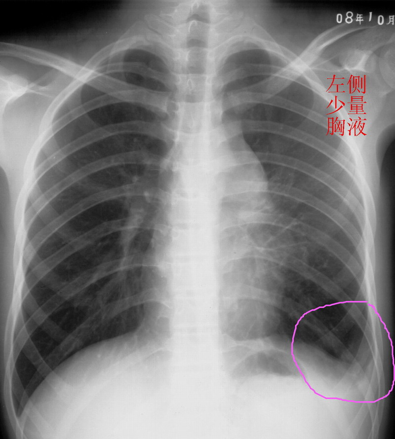 x4978男性17岁去年11月发现左侧胸痛平片检查发现左