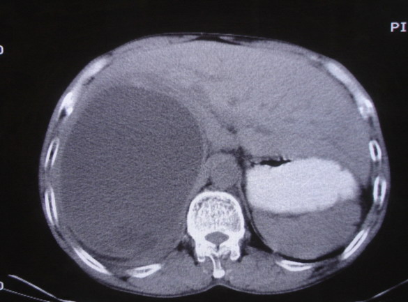 ct16499:男,54,肝区疼痛2月余,肝包虫病?