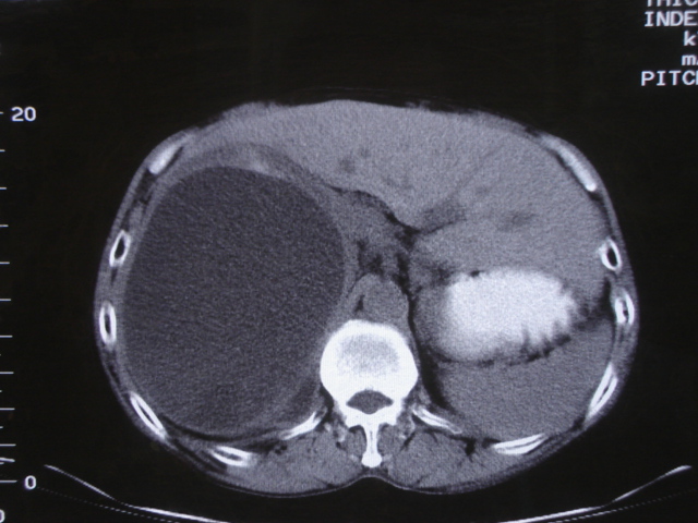 ct16499男54肝区疼痛2月余肝包虫病